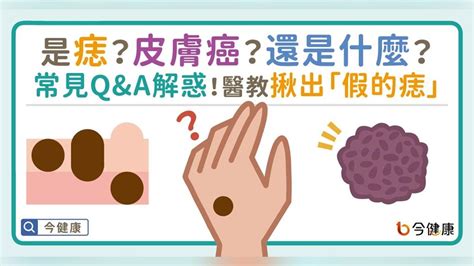 紅色痣代表什麼|是痣？還是皮膚癌？皮膚科醫師教你揪出「假的痣」，。